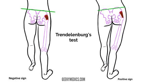 trendelenburg hip exam pdf